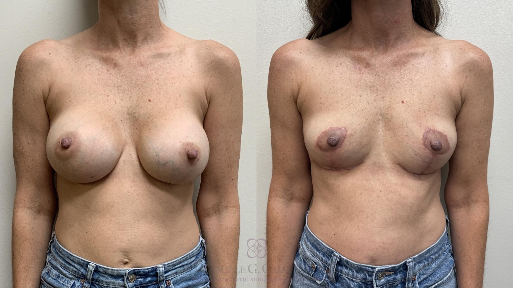 Before & After Breast Implant Removal Case 700 Front View in Houston, TX