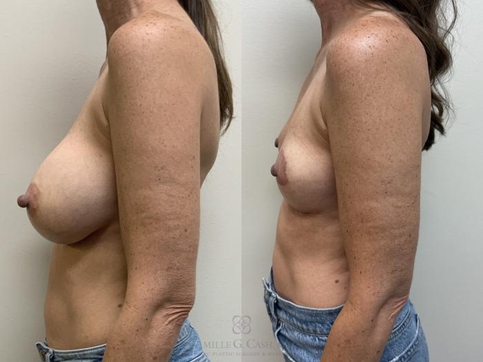 Before & After Breast Implant Removal Case 700 Left Side View in Houston, TX