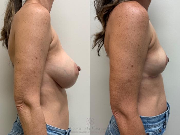 Before & After Breast Implant Removal Case 700 Right Side View in Houston, TX