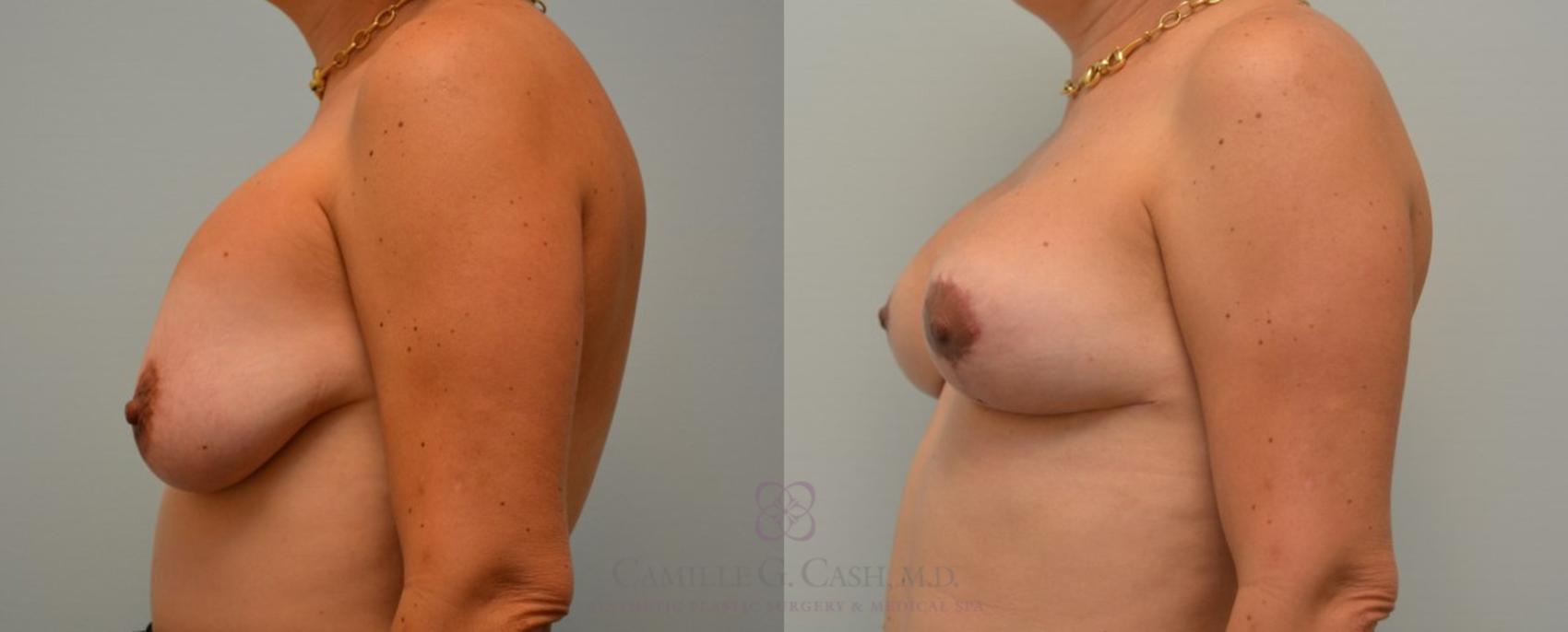 Before & After Breast Implant Removal Case 96 View #2 View in Houston, TX