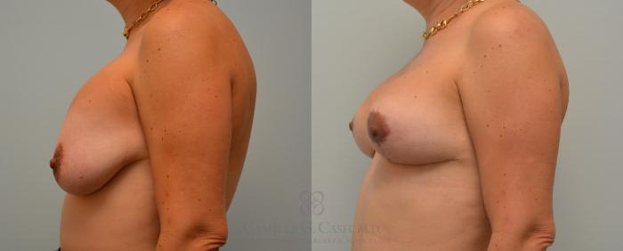 Before & After Implant Exchange and Revision Case 96 View #2 View in Houston, TX