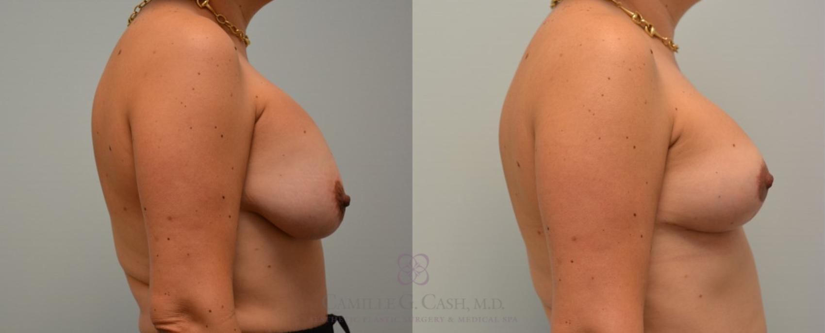 Before & After Breast Implant Removal Case 96 View #3 View in Houston, TX