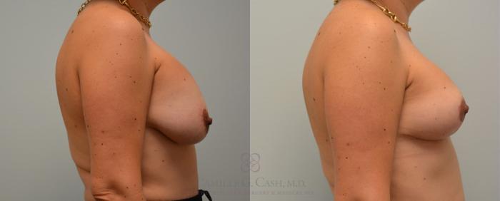 Before & After Implant Exchange and Revision Case 96 View #3 View in Houston, TX