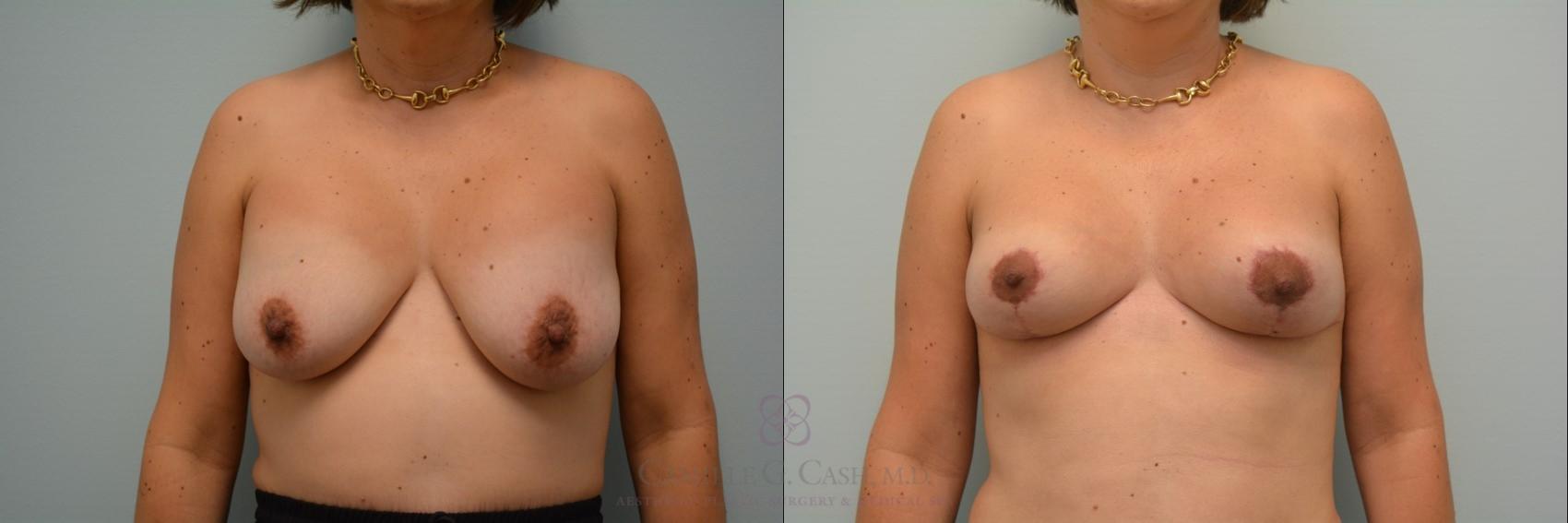 Before & After Breast Implant Removal Case 96 View #4 View in Houston, TX