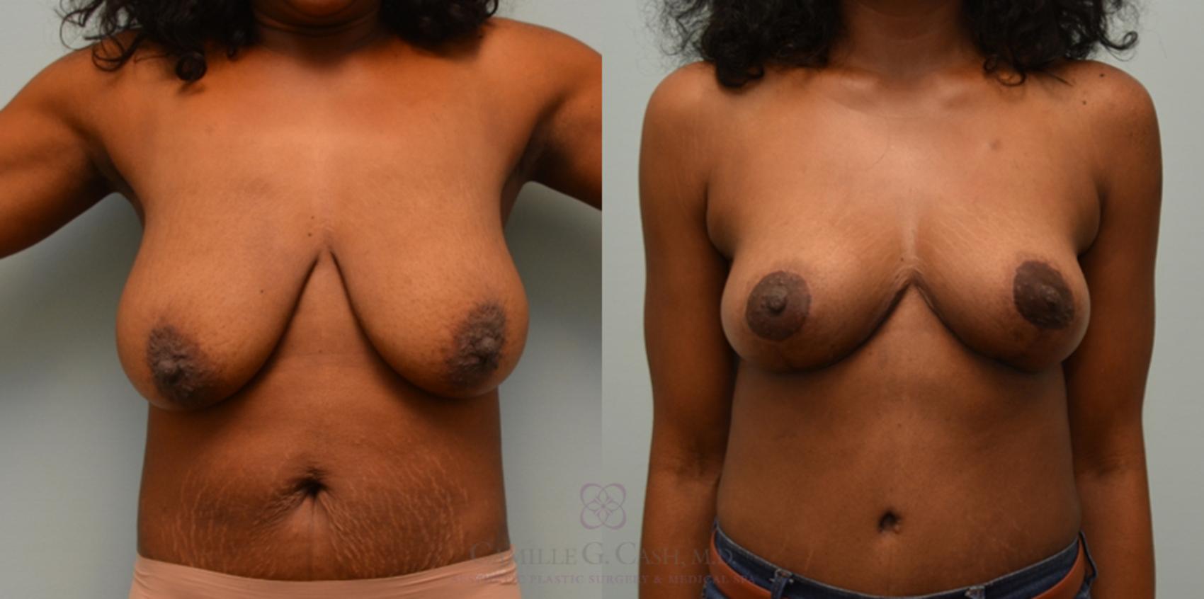 Before & After Breast Lift Case 108 View #1 View in Houston, TX