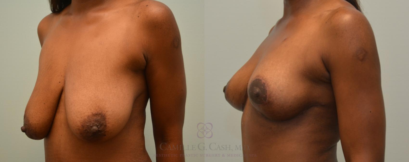 Before & After Breast Lift Case 108 View #2 View in Houston, TX