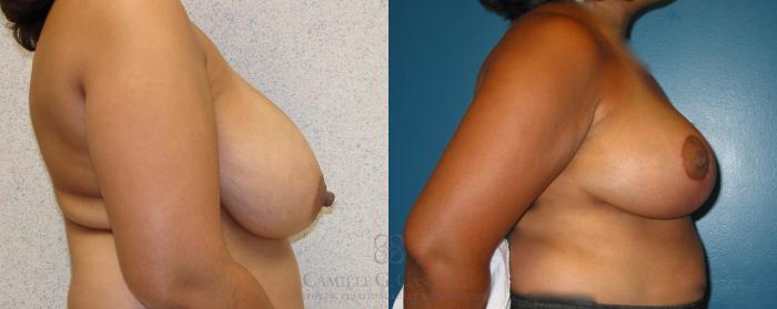 Before & After Breast Lift Case 12 View #2 View in Houston, TX