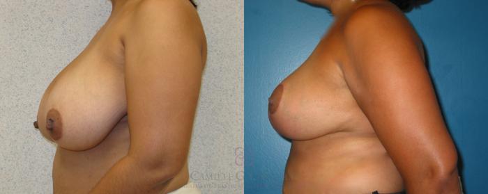 Before & After Breast Lift Case 12 View #4 View in Houston, TX