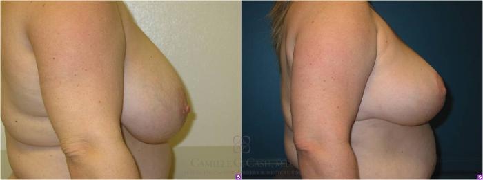 Before & After Breast Lift Case 13 View #2 View in Houston, TX