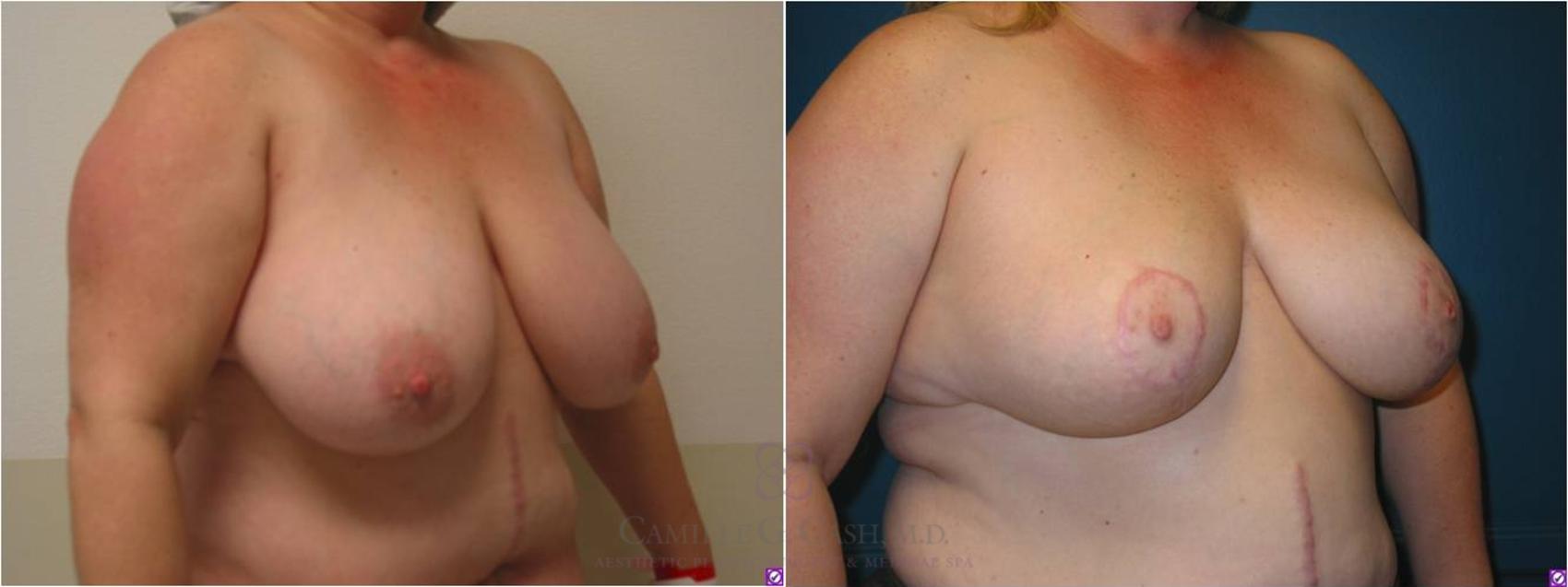 Before & After Breast Lift Case 13 View #3 View in Houston, TX