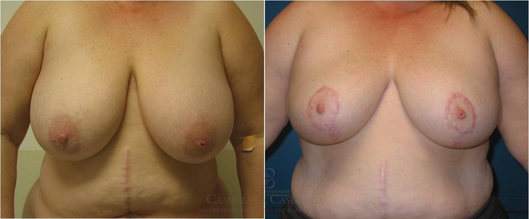Before & After Breast Lift Case 13 View #5 View in Houston, TX