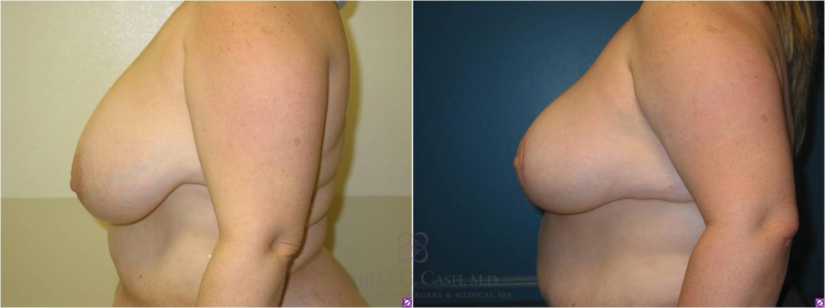 Before & After Breast Lift Case 13 View #6 View in Houston, TX