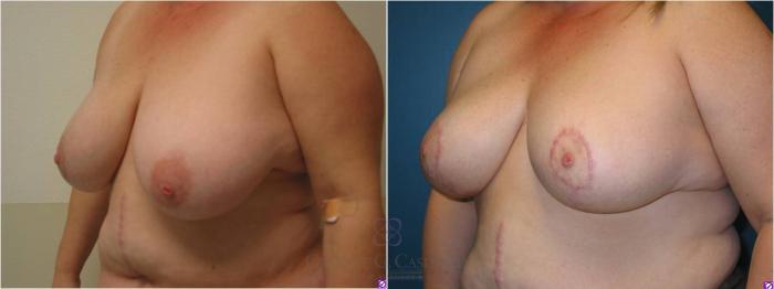 Before & After Breast Lift Case 13 View #7 View in Houston, TX