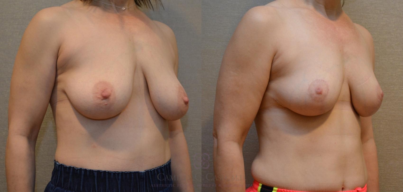 Before & After Breast Lift Case 161 View #2 View in Houston, TX