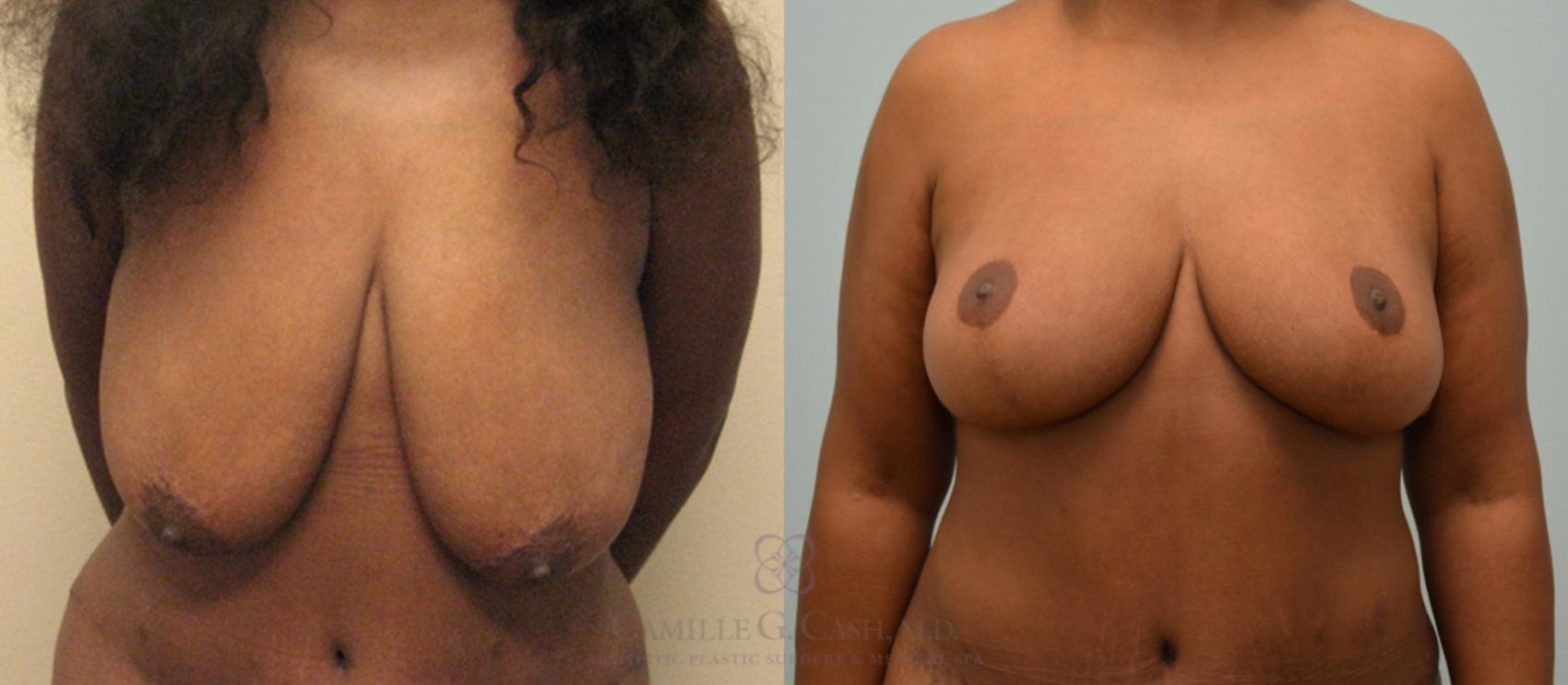 Before & After Breast Lift Case 172 View #1 View in Houston, TX