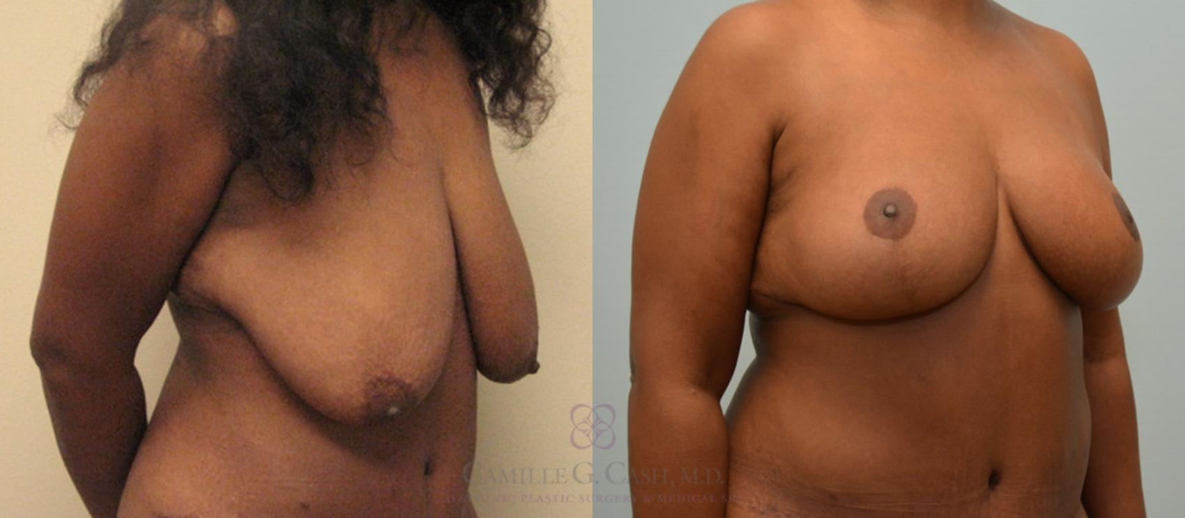 Before & After Breast Lift Case 172 View #2 View in Houston, TX