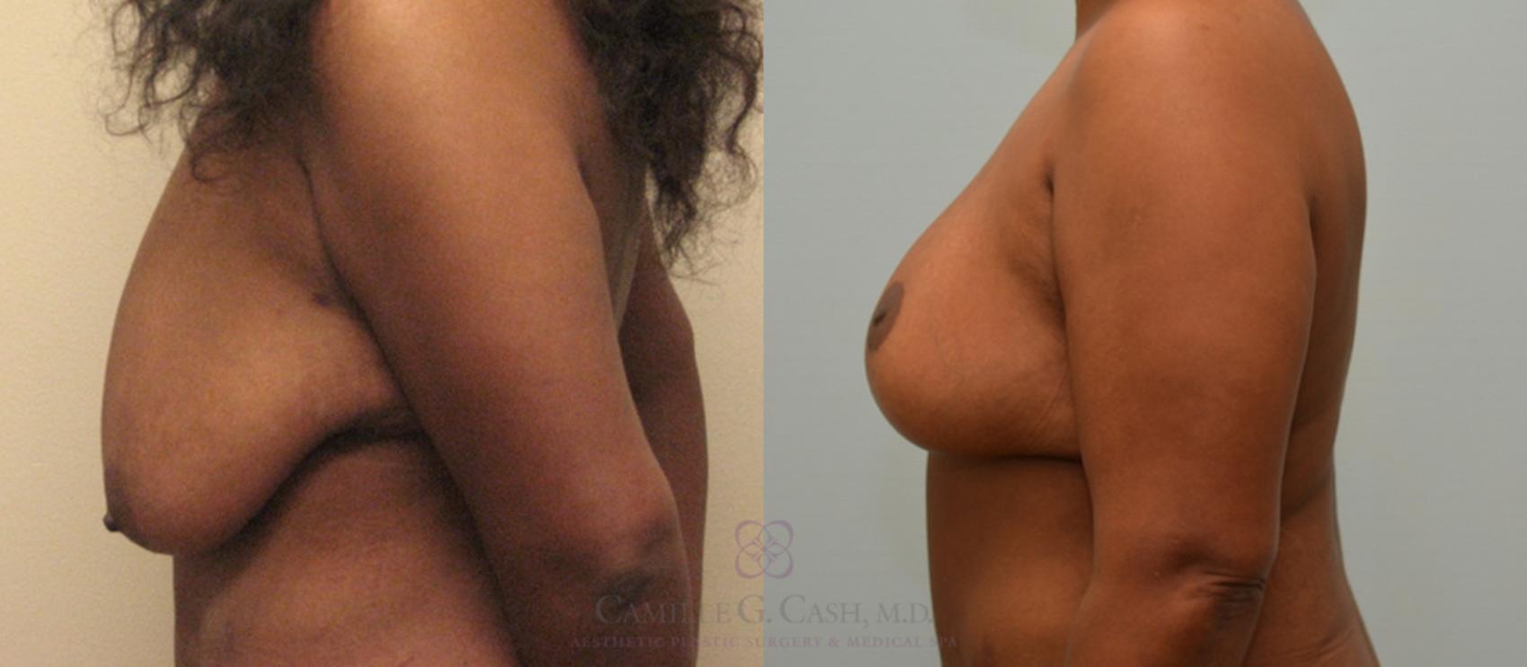 Before & After Breast Lift Case 172 View #3 View in Houston, TX