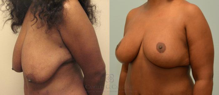 Before & After Breast Lift Case 172 View #4 View in Houston, TX
