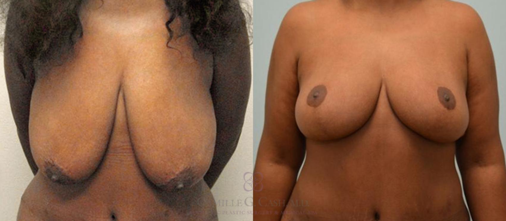 Before & After Breast Lift Case 172 View #5 View in Houston, TX