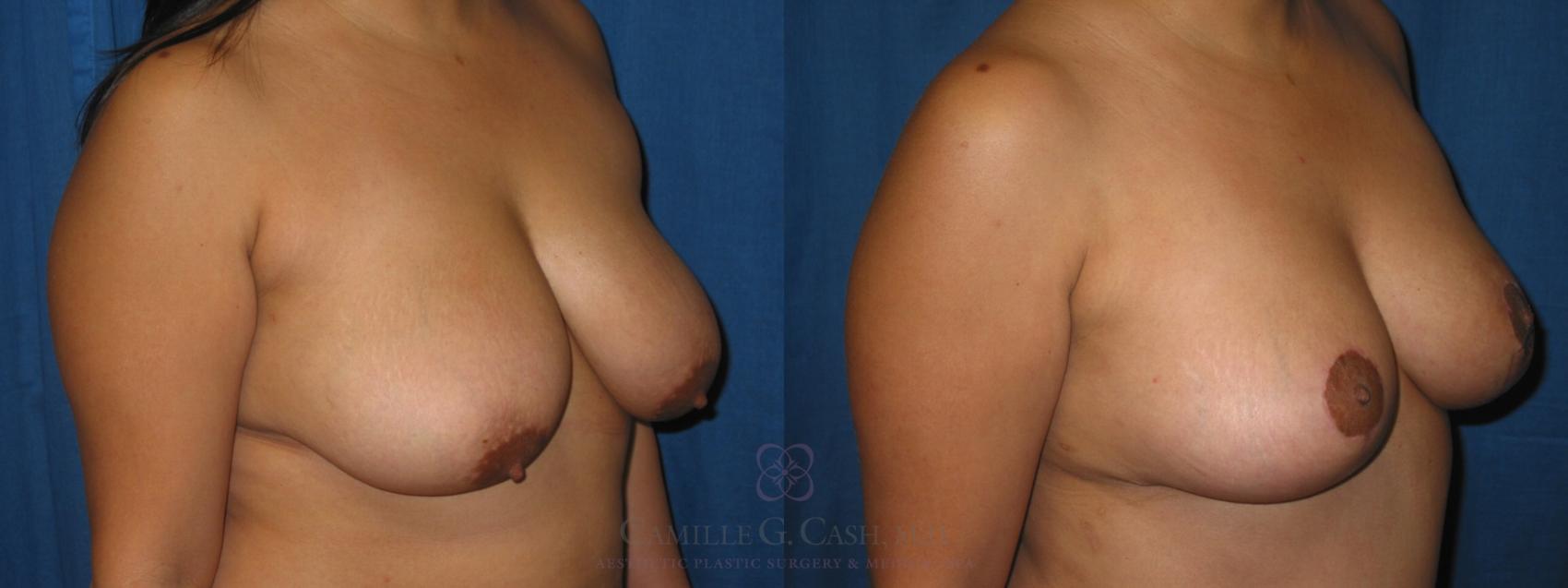 Before & After Breast Lift Case 175 View #1 View in Houston, TX