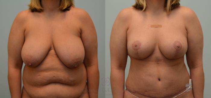 Before & After Breast Lift Case 190 Front View in Houston, TX