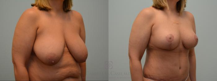 Before & After Breast Lift Case 190 Right Oblique View in Houston, TX