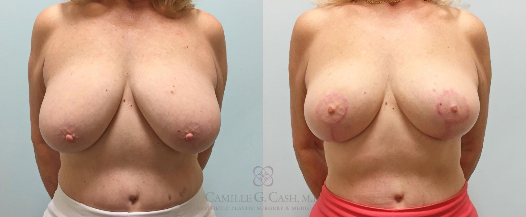 Before & After Breast Lift Case 218 View #1 View in Houston, TX