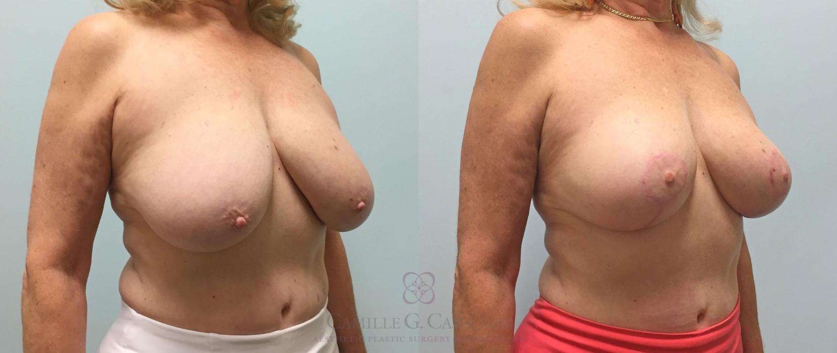 Before & After Breast Lift Case 218 View #2 View in Houston, TX
