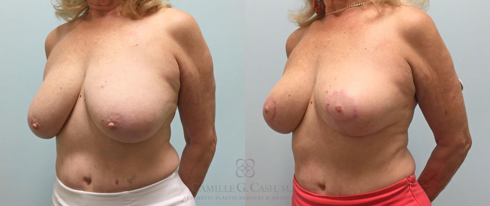 Before & After Breast Lift Case 218 View #3 View in Houston, TX