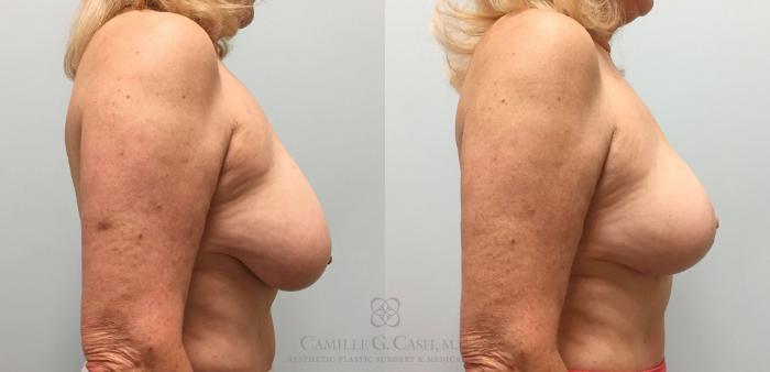 Before & After Breast Lift Case 218 View #4 View in Houston, TX