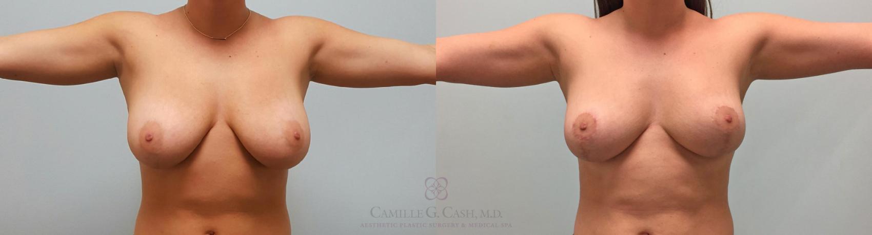 Before & After Breast Lift Case 229 View #1 View in Houston, TX