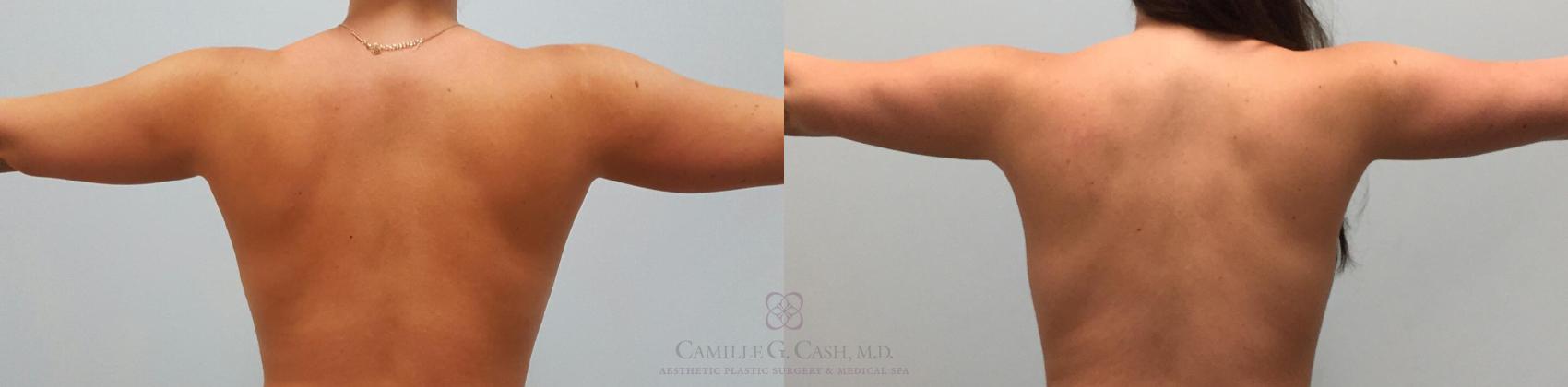 Before & After Breast Lift Case 229 View #2 View in Houston, TX