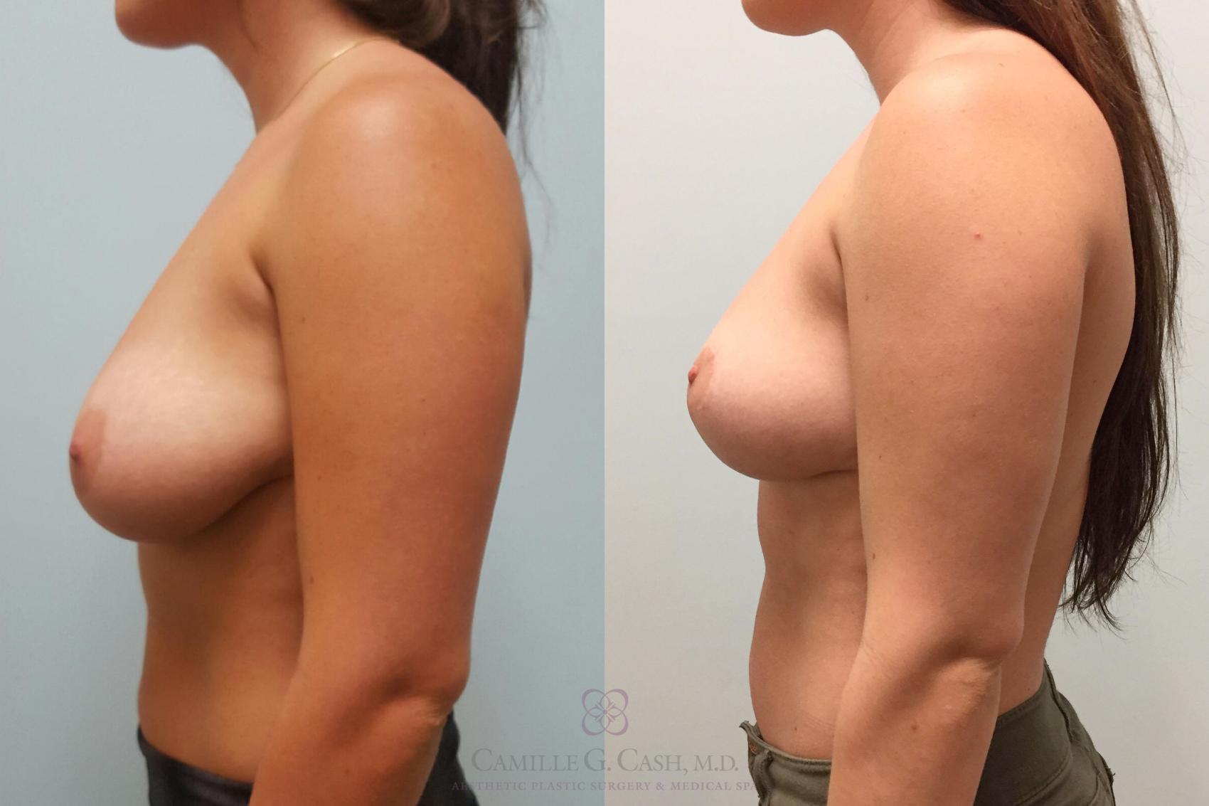 Before & After Breast Lift Case 229 View #3 View in Houston, TX
