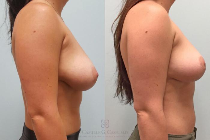 Before & After Breast Lift Case 229 View #4 View in Houston, TX
