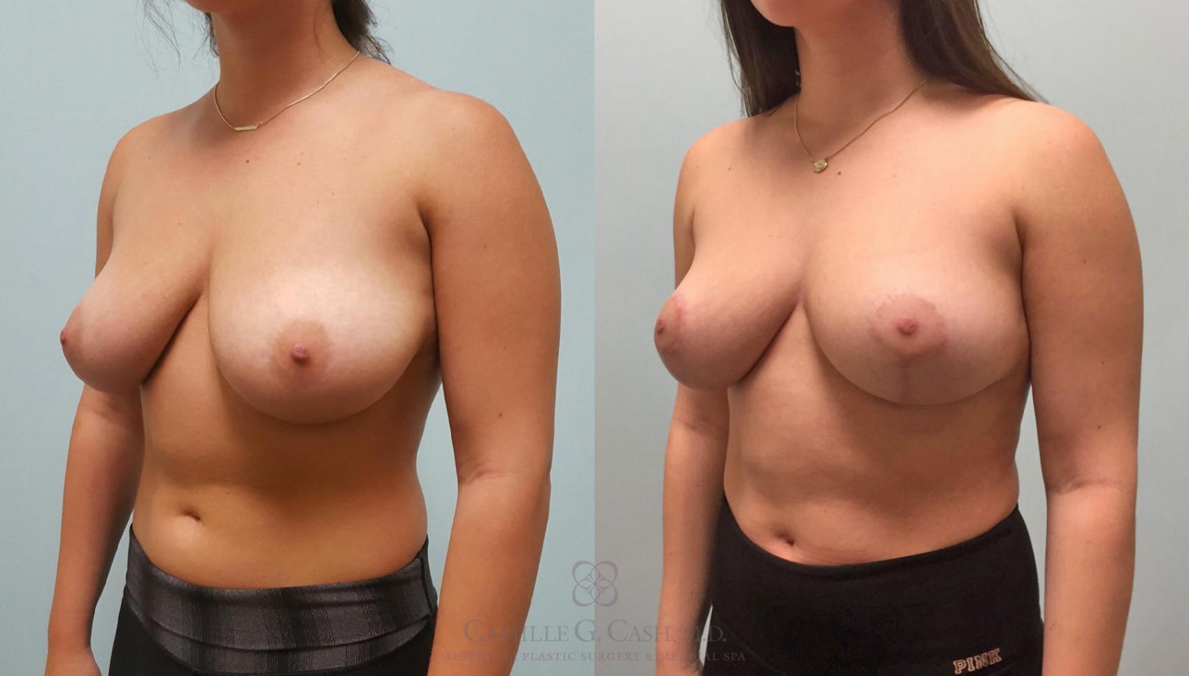 Before & After Breast Lift Case 229 View #6 View in Houston, TX
