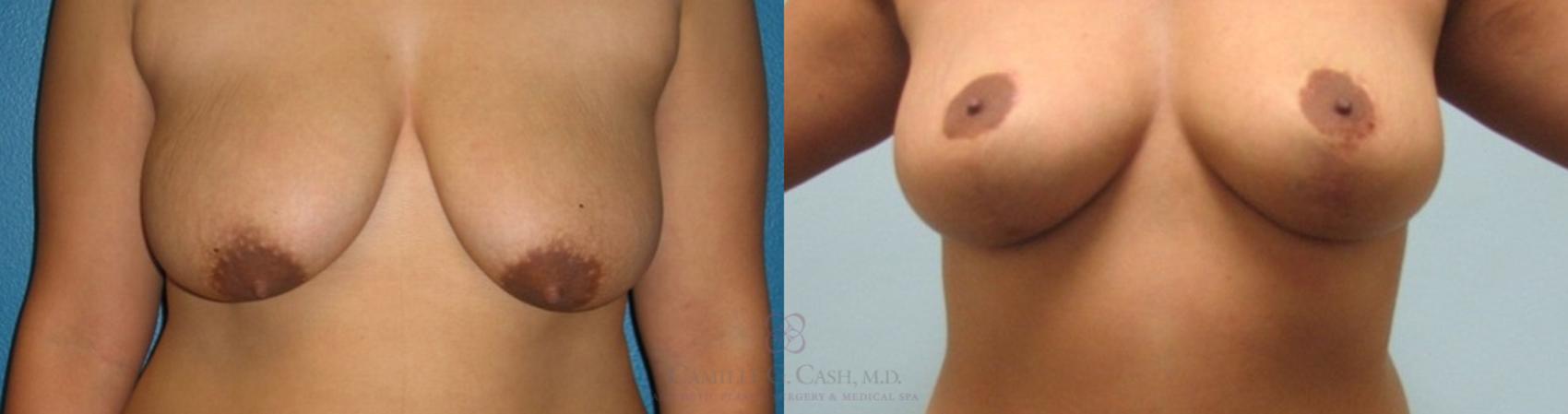 Before & After Breast Lift Case 240 View #1 View in Houston, TX