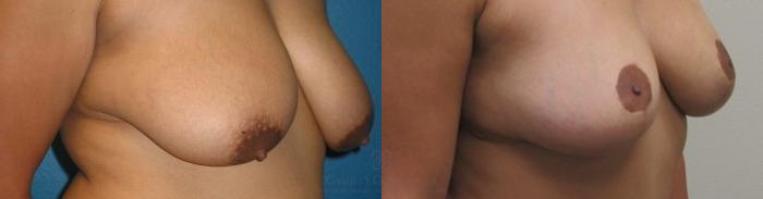 Before & After Breast Lift Case 240 View #2 View in Houston, TX