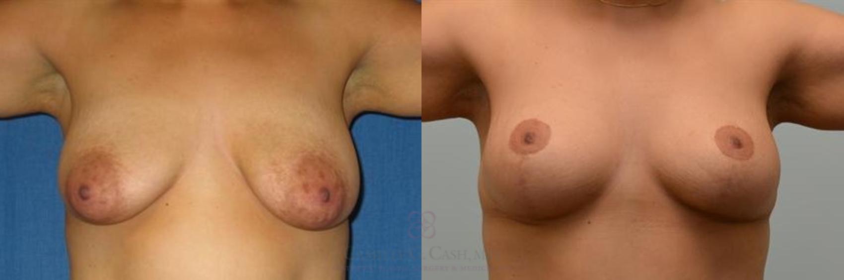 Before & After Breast Lift Case 274 View #1 View in Houston, TX