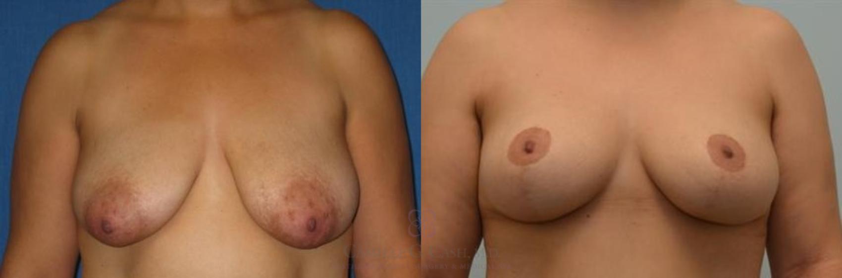 Before & After Breast Lift Case 274 View #2 View in Houston, TX