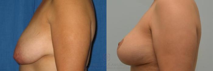 Before & After Breast Lift Case 274 View #3 View in Houston, TX