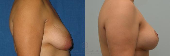 Before & After Breast Lift Case 274 View #4 View in Houston, TX