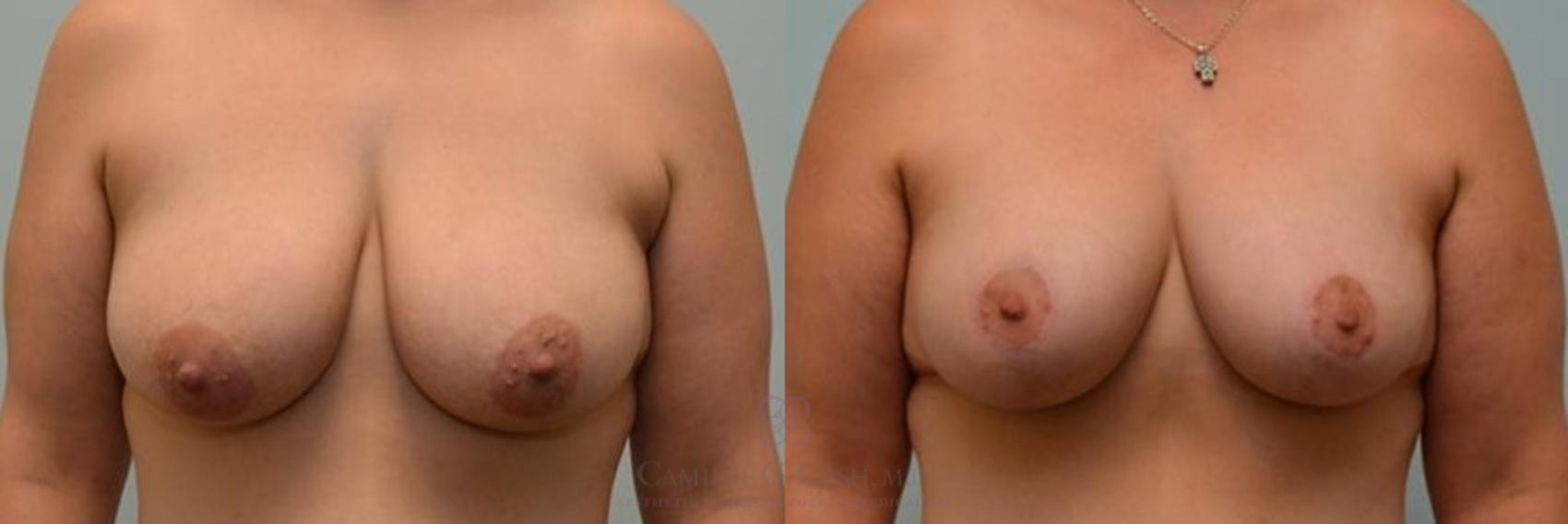 Before & After Breast Lift Case 275 View #1 View in Houston, TX