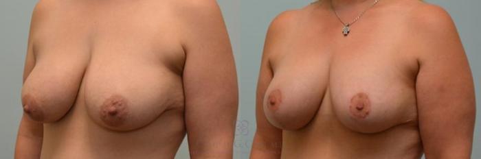 Before & After Breast Lift Case 275 View #2 View in Houston, TX