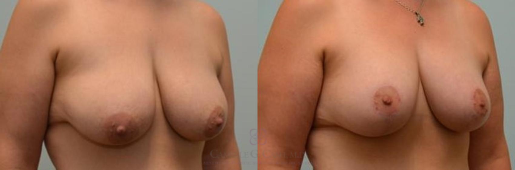 Before & After Breast Lift Case 275 View #3 View in Houston, TX