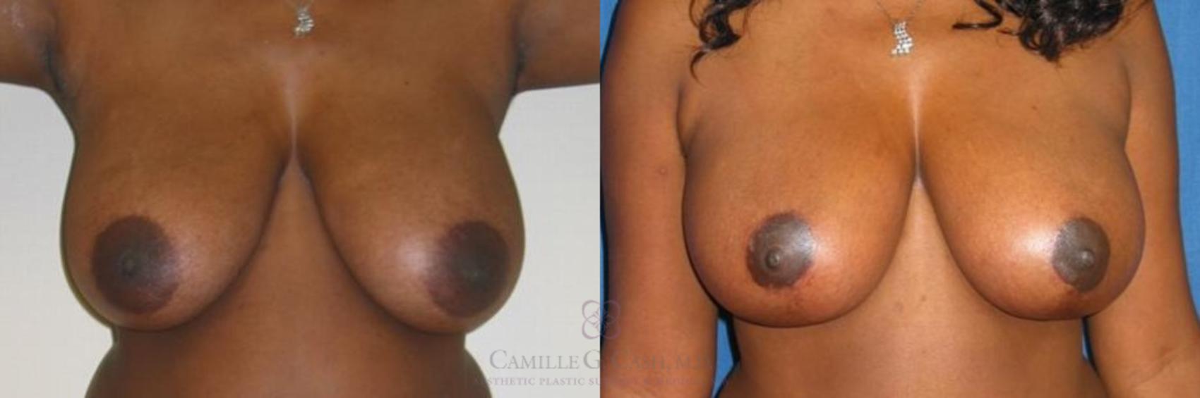 Before & After Breast Lift Case 279 View #1 View in Houston, TX