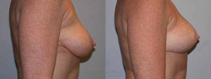 Before & After Breast Lift Case 3 View #1 View in Houston, TX