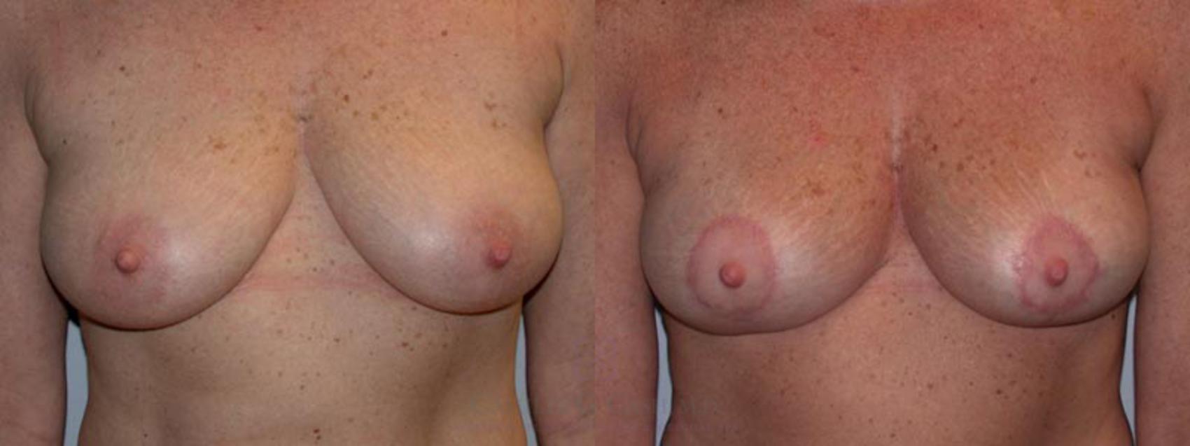 Before & After Breast Lift Case 3 View #2 View in Houston, TX