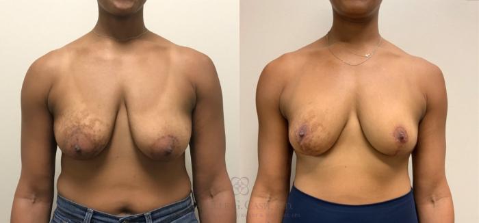 Before & After Breast Lift Case 325 View #1 View in Houston, TX