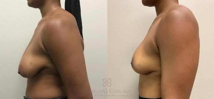 Before & After Breast Lift Case 325 View #2 View in Houston, TX