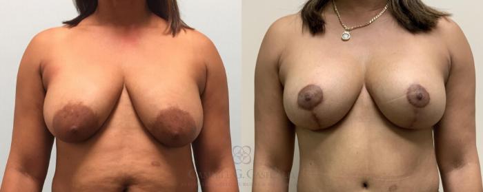 Before & After Breast Lift Case 326 View #1 View in Houston, TX